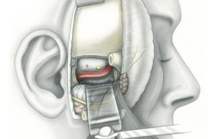 Removal of the middle cranial fossa floor, including the roof of the glenoid fossa and middle meningeal artery, provides exposure of the apical petrous bone and petroclival junction. Downward displacement of the mandibular condyle facilitates exposure of foramen lacerum beneath the intrapetrous carotid artery. This technique also provides excellent exposure of the foramen ovale region. As a general rule, the middle fossa floor can be left in place when addressing lesions confined to the portion of the petrous apex at or above the level of the carotid artery. However, it must be removed for tumors with both intracranial as well extracranial (in the infratemporal fossa) components.