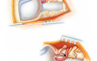 (A) A completed far lateral approach to the foramen magnum prior to dural opening. A laminectomy of the first three cervical vertebrae has been performed. The extent of cervical exposure required depends on the location of the particular tumor being removed. (B) In the so called extreme lateral approach to foramen magnum, the vertebral artery is posteriorly rerouted out of foramen transversarium. This maneuver is used to expose tumors that extend more anteriorly, such as those invading the bodies of the upper cervical vertebrae. This infrequently used technique must be performed with care to avoid arterial injury.