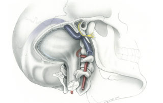 Another view of a completed far lateral approach to foramen magnum prior to dural opening illustrating the relationships of the vertebral artery (VA) as it passes through the foramen tranversarium, crosses the first cervical vertebra, and traverses the dura into the posterior cranial fossa. (JV, jugular vein)