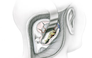 Following dural incision and elevation of the cerebellum, the lateral surface of the medulla and upper cervical spinal cord comes into view. The space anterior to the brainstem and spinal cord can be seen through a veil of cranial and spinal nerves. (Cb, cerebellum; M, medulla; CSC, cervical spinal cord; 7 and 8, facial and audiovestibular nerves; 9, glossopharyngeal nerve; 10, vagus nerve; 11c, cranial branch of the acessory nerve, 11s, spinal branch of the accessory nerve; 12, hypoglossal nerve; C, first cervical root.)