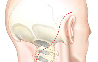 The incision (dashed line) used in the far lateral approach must afford access to the suboccipital regions, the upper spine, as well as the petrous bone. (A) One option for incision is an opening which curves gradually from behind the ear to the upper neck by way of the suboccitpial region. (B) Another is an inferiorly based flap.