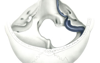 Bone removal in the far lateral approach to foramen magnum as seen from above. The lateral aspect of foramen magnum has been removed up to the vicinity of the jugular foramen and hypoglossal canal (HC).