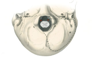 Bone removal in the far lateral approach to foramen magnum as seen from below. Laterally, the anterior limits of the exposure are the ear canal (EC), facial nerve (FN), and jugular foramen (JF). Medially, a variable amount of the occipital condyle (C) is removed, usually one half to two thirds of its length. More radical removal of the condyle may necessitate additional measures to insure stabilization of the cervical spine.