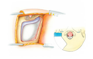 A mastoidectomy is performed with identification of the descending portion of the facial nerve (FN). This measure is necessary to safely skeletonize the posterior margin of the sigmoid sinus to the jugular bulb.