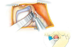 The plate of cranial base bone situated lateral to the condyle is then drilled away. Extradural elevation of the cerebellum facilitates this maneuver.